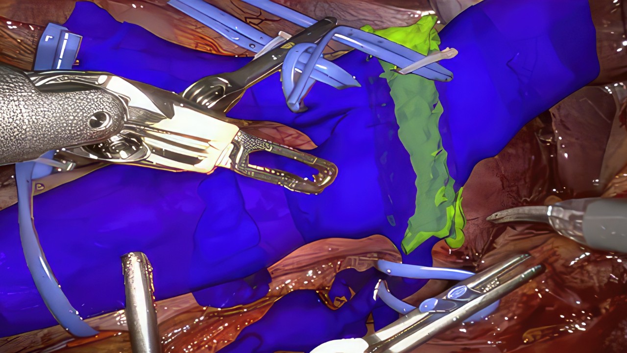 NVIDIA Holoscan: IA in tempo reale in chirurgia